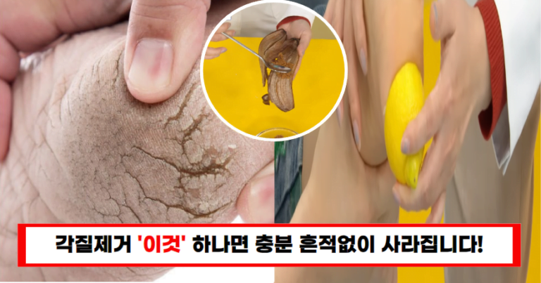 “갓 태어난 애기처럼 뽀송해졌습니다!”이것 하나로 발주변 각질 녹여버리세요!