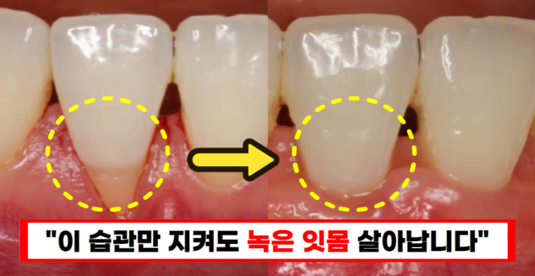 “녹아내리는 잇몸 더 늦기 전에 이렇게 해보세요” 따라만 해도 다시 짱짱해집니다!